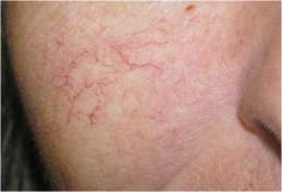 capilares-dilatados-en-la-cara